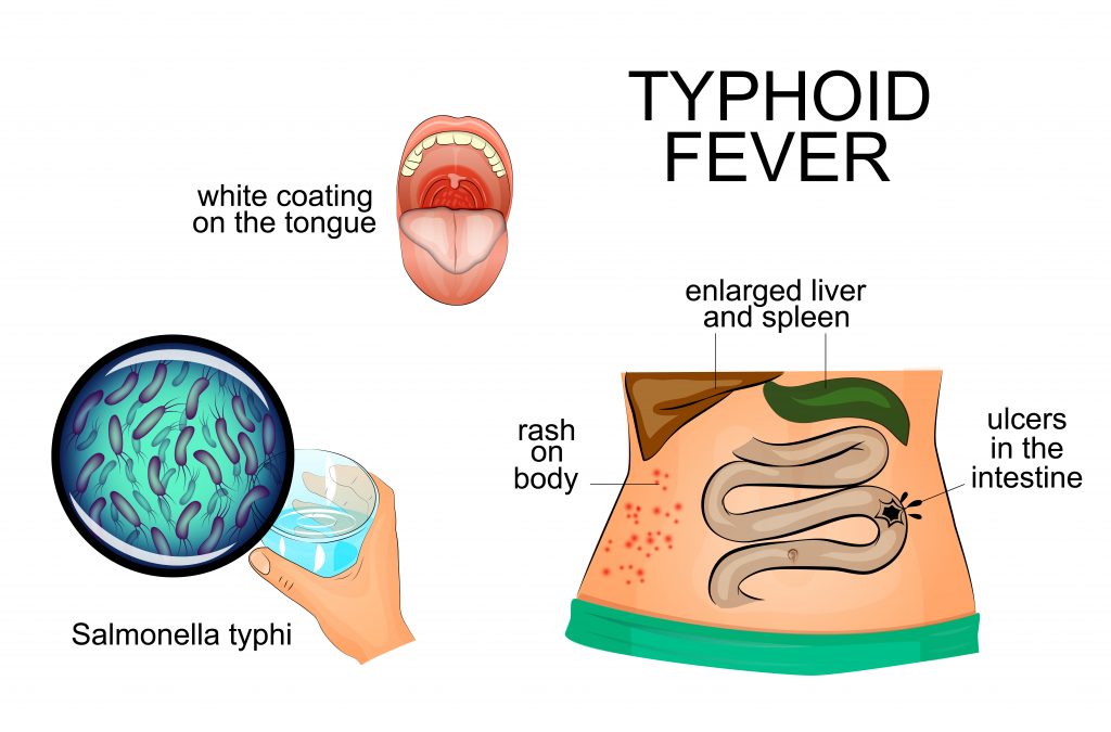 Typhoid 